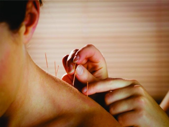ACUPUNTURA
